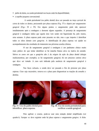 • palito de dente, ou sonda periodontal nos locais onde há disponibilidade;
• e espelho pequeno convencional.
               A sonda periodontal (ou palito dental) deve ser passada no terço cervical da
coroa de todos os dentes, procurando por placa espessa (Fig. 37) e depois por sangramento
gengival (Fig.s 38 e 39). Em alguns pontos o sangramento pode não aparecer
imediatamente após a sondagem e demorar alguns segundos. A presença de sangramento
gengival à sondagem indica que aquela área vem sendo má higienizada há, pelo menos,
uma semana. A placa espessa pode estar presente ou não, mas o que importa é identificar
todos os sítios dentais com gengivite. A identificação da placa espessa vai ajudar no
acompanhamento dos resultados do tratamento nas próximas sessões clínicas.
             O uso do sangramento gengival à sondagem é um parâmetro clínico muito
mais prático do que tentar identificar se há mancha branca ativa ou inativa de esmalte.
Salvos os casos em que a gengivite não é de origem da ação da placa dental (alergia
medicamentosa, por exemplo), se há sangramento gengival, há um processo carioso ativo
que deve ser tratado. A cura será indicada pela ausência de sangramento gengival à
sondagem.
             Nas faces oclusais, a sonda deve ser passada a fim de procurar por placa
espessa. Caso seja necessário, remove-se a placa para diagnosticar as reações de esmalte e
dentina.




Fig. 37. Uso do palito dental para                Fig. 38. Uso da sonda periodontal para
identificar placa espessa.                                 verificar a saúde gengival.

             Para agilizar o exame, pode-se usar uma notação dental simplificada (ver
quadro1). Sempre se deve registrar onde há placa espessa e sangramento gengiva. A ficha


                                                                                         48
 