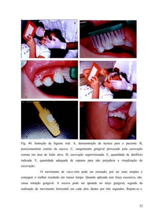 Fig. 40. Instrução de higiene oral. A, demonstração da técnica para o paciente. B,
posicionamento correto da escova. C, sangramento gengival provocado pela escovação
correta em área de lesão ativa. D, escovação supervisionada. E, quantidade de detifrício
indicada. F, quantidade adequada de espuma para não prejudicar a visualização da
escovação.
              O movimento de vai-e-vém pode ser ensinado, por ser mais simples e
conseguir o melhor resultado em menor tempo. Quando aplicada sem força excessiva, não
causa retração gengival. A escova pode ser apoiada no terço gengival, seguida da
realização de movimento horizontal em cada dois dentes por três segundos. Repete-se o




                                                                                     52
 
