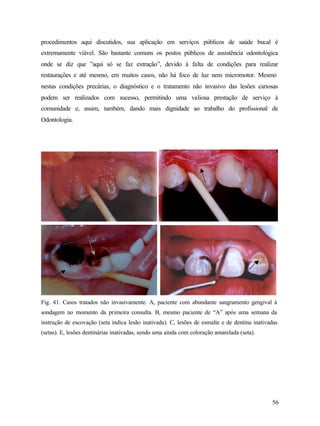 procedimentos aqui discutidos, sua aplicação em serviços públicos de saúde bucal é
extremamente viável. São bastante comuns os postos públicos de assistência odontológica
onde se diz que ”aqui só se faz extração”, devido à falta de condições para realizar
restaurações e até mesmo, em muitos casos, não há foco de luz nem micromotor. Mesmo
nestas condições precárias, o diagnóstico e o tratamento não invasivo das lesões cariosas
podem ser realizados com sucesso, permitindo uma valiosa prestação de serviço à
comunidade e, assim, também, dando mais dignidade ao trabalho do profissional de
Odontologia.




Fig. 41. Casos tratados não invasivamente. A, paciente com abundante sangramento gengival à
sondagem no momento da primeira consulta. B, mesmo paciente de “A” após uma semana da
instrução de escovação (seta indica lesão inativada). C, lesões de esmalte e de dentina inativadas
(setas). E, lesões dentinárias inativadas, sendo uma ainda com coloração amarelada (seta).




                                                                                               56
 