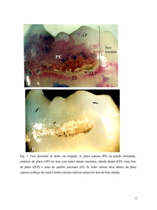 AP

                                                                        Parte
                                                                        irrompida
                             PE


                                                          ZLP
                                           EJ
             A




         B
Fig. 1. Face proximal de dente em erupção. A, placa espessa (PE) na porção irrompida,
ausência de placa (AP) na área com maior atrição mecânica, cálculo dental (CD), zona livre
de placa (ZLP) e zona do epitélio juncional (EJ). B, lesão cariosa ativa abaixo da placa
espessa (cabeça–de-seta) e lesões cariosas inativas (setas) em área de forte atrição.




                                                                                         4
 