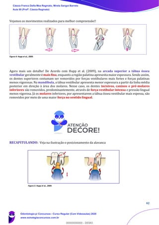 42
Vejamos os movimentos realizados para melhor compreensão!!
Figura 4: Hupp et al., 2009.
Agora mais um detalhe! De Acordo com Hupp et al. (2009), na arcada superior a tábua óssea
vestibular geralmente é mais fina, enquanto a região palatina apresenta maior espessura. Sendo assim,
os dentes superiores costumam ser removidos por forças vestibulares mais fortes e forças palatinas
menos vigorosas. Na mandíbula, a tábua vestibular apresenta menor espessura a partir da linha média
posterior em direção à área dos molares. Nesse caso, os dentes incisivos, caninos e pré-molares
inferiores são removidos, predominantemente, através de força vestibular intensa e pressão lingual
menos vigorosa. Já os molares inferiores, por apresentarem a tábua óssea vestibular mais espessa, são
removidos por meio de uma maior força no sentido lingual.
RECAPITULANDO: Veja na ilustração o posicionamento da alavanca
Figura 5: Hupp et al., 2009.
Cássia Franco Della Mea Reginato, Mirela Sangoi Barreto
Aula 00 (Profª. Cássia Reginato)
Odontologia p/ Concursos - Curso Regular (Com Videoaulas) 2020
www.estrategiaconcursos.com.br
0
00000000000 - DEMO
 