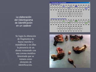 La elaboración del Odontograma de Identificación en un cadáver Se logra la obtención de fragmentos de hueso maxilar y mandibular y en ellas la presencia de un diente restaurado con una corona metálica fenestrada que se tomara como elemento de identificación.  