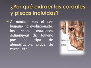 A medida que el ser humano ha evolucionado, los arcos maxilares disminuyen de tamaño por el tipo de alimentación, cruce de razas, etc.  