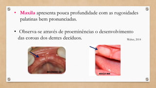 • Maxila apresenta pouca profundidade com as rugosidades
palatinas bem pronunciadas.
• Observa-se através de proeminências o desenvolvimento
das coroas dos dentes decíduos. Walter, 2014
 
