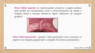 Freio labial superior no recém-nascido estende-se à papila palatina
para auxiliar na amamentação. Com o desenvolvimento da maxila e
erupção dental a inserção desloca-se alguns milímetros da margem
gengival.
Guedes Pinto, 2009
Freio labial persistente quando o freio permanece com a inserção na
papila ou na margem gengival após a irrupção do incisivos permanentes.
 