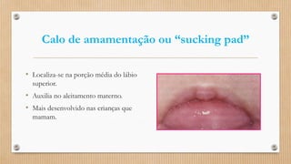 Calo de amamentação ou “sucking pad”
• Localiza-se na porção média do lábio
superior.
• Auxilia no aleitamento materno.
• Mais desenvolvido nas crianças que
mamam.
 