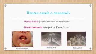 Dentes natais e neonatais
-Dentes natais: já estão presentes ao nascimento
-Dentes neonatais: irrompem no 1º mês de vida
Walter, 2014Google imagens Walter, 2014
 