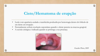 Cisto/Hematoma de erupção
• Lesão com aparência azulada e translúcida produzida por hemorragia dentro do folículo de
um dente em irrupção.
• Normalmente sofrem resolução espontânea quando o dente penetra na mucosa gengival.
• A excisão cirúrgica é indicada quando se prolonga a sua presença.
Guedes Pinto, 2009
 