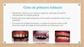 Cárie de primeira infância
• Inicialmente, observa-se nos incisivos superiores a presença de manchas
esbranquiçadas na margem gengival.
• Podem apresentar rápida progressão com cavitação estendendo-se para outras
superfícies.
• Na ausência de medidas preventivas, a evolução do processo carioso pode
determinar ampla destruição da coroa dentária até a destruição total.
Google imagens
 