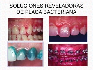 SOLUCIONES REVELADORAS
  DE PLACA BACTERIANA
 