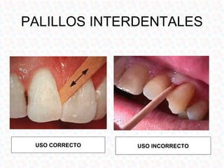 PALILLOS INTERDENTALES




 USO CORRECTO   USO INCORRECTO
 