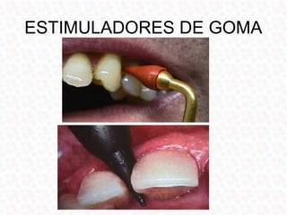 ESTIMULADORES DE GOMA
 