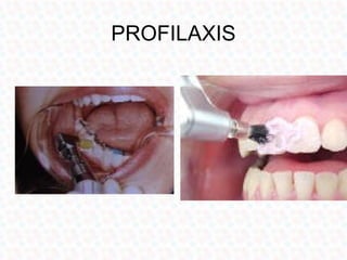 PROFILAXIS
 
