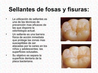 Sellantes de fosas y fisuras:
•    La utilización de sellantes es
     una de las técnicas de
     prevención mas eficaces de
     las que dispone la
     odontología actual.
•    Un sellante es una barrera
     física de acción inmediata
     que protege las zonas mas
     susceptibles de ser
     atacadas por la caries en los
     niños y adolescentes: las
     superficies oclusales.
•    Su objetivo es separa la
     superficie dentaria de la
     placa bacteriana.
 