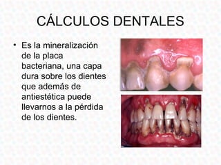 CÁLCULOS DENTALES
• Es la mineralización
  de la placa
  bacteriana, una capa
  dura sobre los dientes
  que además de
  antiestética puede
  llevarnos a la pérdida
  de los dientes.
 