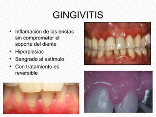GINGIVITIS
• Inflamación de las encías
  sin comprometer el
  soporte del diente
• Hiperplasias
• Sangrado al estímulo
• Con tratamiento es
  reversible
 
