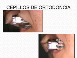 CEPILLOS DE ORTODONCIA
 