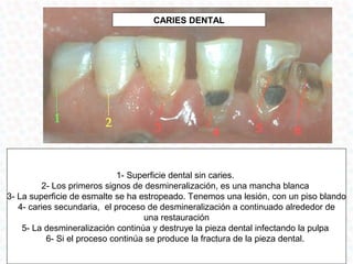 CARIES DENTAL




                             1- Superficie dental sin caries.
         2- Los primeros signos de desmineralización, es una mancha blanca
3- La superficie de esmalte se ha estropeado. Tenemos una lesión, con un piso blando
   4- caries secundaria, el proceso de desmineralización a continuado alrededor de
                                    una restauración
    5- La desmineralización continúa y destruye la pieza dental infectando la pulpa
           6- Si el proceso continúa se produce la fractura de la pieza dental.
 