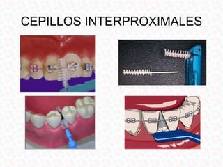 CEPILLOS INTERPROXIMALES
 