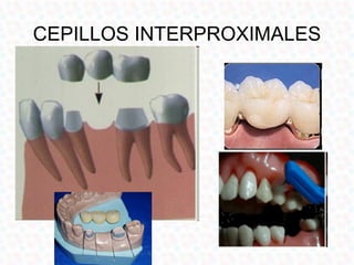 CEPILLOS INTERPROXIMALES
 