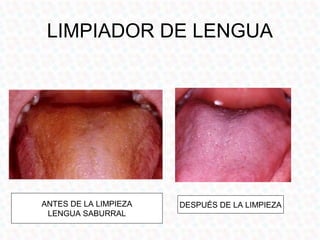 LIMPIADOR DE LENGUA




ANTES DE LA LIMPIEZA   DESPUÉS DE LA LIMPIEZA
 LENGUA SABURRAL
 