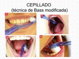 CEPILLADO
(técnica de Bass modificada)
 