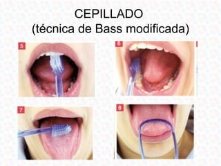 CEPILLADO
(técnica de Bass modificada)
 