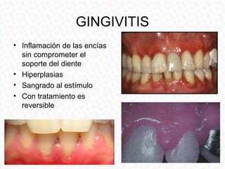 GINGIVITIS
• Inflamación de las encías
  sin comprometer el
  soporte del diente
• Hiperplasias
• Sangrado al estímulo
• C...