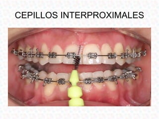 CEPILLOS INTERPROXIMALES
 