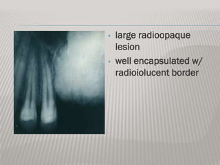 •   large radioopaque
    lesion
•   well encapsulated w/
    radioiolucent border
 