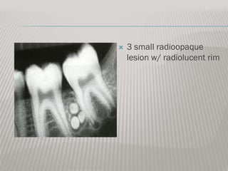    3 small radioopaque
    lesion w/ radiolucent rim
 