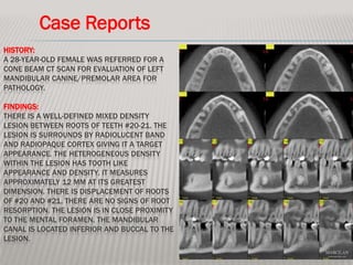 Case Reports
HISTORY:
A 28-YEAR-OLD FEMALE WAS REFERRED FOR A
CONE BEAM CT SCAN FOR EVALUATION OF LEFT
MANDIBULAR CANINE/PREMOLAR AREA FOR
PATHOLOGY.

FINDINGS:
THERE IS A WELL-DEFINED MIXED DENSITY
LESION BETWEEN ROOTS OF TEETH #20-21. THE
LESION IS SURROUNDS BY RADIOLUCENT BAND
AND RADIOPAQUE CORTEX GIVING IT A TARGET
APPEARANCE. THE HETEROGENEOUS DENSITY
WITHIN THE LESION HAS TOOTH LIKE
APPEARANCE AND DENSITY. IT MEASURES
APPROXIMATELY 12 MM AT ITS GREATEST
DIMENSION. THERE IS DISPLACEMENT OF ROOTS
OF #20 AND #21. THERE ARE NO SIGNS OF ROOT
RESORPTION. THE LESION IS IN CLOSE PROXIMITY
TO THE MENTAL FORAMEN. THE MANDIBULAR
CANAL IS LOCATED INFERIOR AND BUCCAL TO THE
LESION.
 