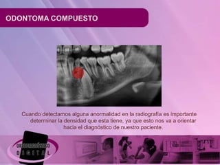 ODONTOMA COMPUESTO




   Cuando detectamos alguna anormalidad en la radiografía es importante
      determinar la densidad que esta tiene, ya que esto nos va a orientar
                    hacia el diagnóstico de nuestro paciente.
 