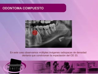 ODONTOMA COMPUESTO




   En este caso observamos múltiples imágenes radiopacas de densidad
             dentaria que condicionan la impactación del OD 33.
 
