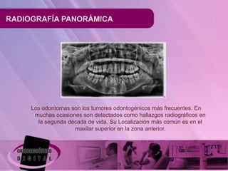 RADIOGRAFÍA PANORÁMICA




     Los odontomas son los tumores odontogénicos más frecuentes. En
      muchas ocasiones son detectados como hallazgos radiográficos en
       la segunda década de vida. Su Localización más común es en el
                    maxilar superior en la zona anterior.
 