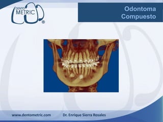 www.dentometric.com Dr. Enrique Sierra Rosales
Odontoma
Compuesto
 