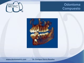 www.dentometric.com Dr. Enrique Sierra Rosales
Odontoma
Compuesto
 