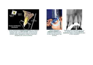 Técnica radiográfica da Bissetriz Excêntrica com incidência        Técnica radiográfica          Radiografia para confirmação do CRT ou
 do feixe de raios X no ápice do dente, conferindo menor       daBissetriz Exêntrica com          CT, tomada com a técnica daBissetriz
  distorção neste, porém a coroa e terço cervical radicular   incidência do feixe de raios X    Excêntrica. Manter a centralização do ápice
  sofrerão imagens radiográficas cortadas ou distorcidas /    no terço radicular apical, seta              no filme radiográfico
            alongadas (sem nenhum problema)                             vermelha
 