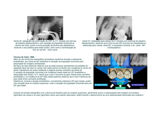Dente 26, radiografia de confirmação do CRT ou CT, tomada com técnica            Dente 27, radiografia para cálculo do X, tomada com a técnica da bissetriz
 da bissetriz distoexcêntrica, com variação da angulação horizontal ou          distoexcêntrica, observar que a lima na raiz MV encontra-se mesializada ou
 técnica de Clark, porém a única exceção da técnica que distalizamos,            deslocada para mesial, canal MV, é necessário localizar o 4o. canal - MP
observar a raiz palatina para distal (maior), bem como a centralização da                                      (mesiopalatino)
                       lima na raiz MV - único canal


Técnica de Clark, 1909:
Além do uso da técnica radiográfica da bissetriz excêntrica durante o tratamento
endodôntico, por vezes se faz necessário a variação da angulação horizontal para
dissociação de imagens sobrepostas.
Na figura ao lado podemos observar que as setas brancas representam as posições do
cabeçote (feixe de raios X), sendo orto-radial (centro do dente) com incidência no centro do
dente, sobrepondo as raízes vestibular e palatina (pontos vermelho) do dente 24.
A variação da angulação horizontal com incidência mesio-radial em 20º possibilitou a
dissociação das raízes V e P, sendo que a raiz P encontra-se para mesial (linha vermelha
pontilhada) e, na incidência de 20º disto-radial podemos observar que a raiz P deslocou-se
para distal (linha vermelha pontilhada).
Salienta-se, durante a terapia endodôntica, normalmente utilizamos 20º para mesial, porém
com exceção para os molares superiores, onde a variação da angulação horizontal seria em
20º para distal.


Quando da tomada radiográfica com a técnica da bissetriz para os molares superiores, geralmente ocorre a sobreposição das imagens do processo
zigomático da maxila e do osso zigomático sobre seus ápices radiculares, determinando o aparecimento de uma radiopacidade acentuada que impede a
 