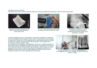 zigomático e ápices radiculares.
Vale lembrar que, para os molares superiores utilizamos a técnica da bissetriz disto-excêntrica, conforme citado anteriormente.




 Apreensão do rolete de algodão com fita                 Filme com rolete em posição e diminuição                    Dissociação das imagens, processo
  adesiva, proporcionando paralelismo                    do ângulo de incidência vertical do raio X                    zigomático e ápices radiculares.
           entre dente e filme                                                                                      Associação das técnicas bissetriz disto-
                                                                                                                            excêntrica e Le Master



A tomada radiográfica inicial ou de diagnóstico do tratamento endodôntico é obtida pela
técnica do paralelismo (filme paralelo ao dente), porém o posicionador deve ser colocado
em posição, de tal forma que, o filme periapical fique o mais paralelo possível em relação
ao dente, caso contrário a imagem poderá sofrer distorções, como alongamento ou
encurtamento, conforme figuras a seguir.
Se o alongamento for demasiado, na radiografia do cálculo do X, a distância da ponta do
instrumento ao vértice radiográfico será bem menor do que foi subtraído do CAD (3mm ou
5mm, dependendo da sua Escola) podendo até ultrapassar o vértice, lesando os tecidos
periapicais e, ao contrário, se houver encurtamento, na radiografia do cálculo do X, a
distância da ponta do instrumento ao vértice radiográfico será bem maior do que foi
                                                                                                 Tomada radiográfica com a técnica do paralelismo de
subtraído do CAD (3mm ou 5mm, dependendo da sua Escola).
                                                                                              forma correta, observar que a imagem do vértice radicular do
                                                                                                                   dente 21 é nítida
 