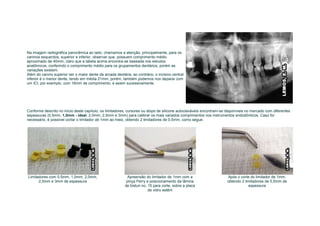 Na imagem radiográfica panorâmica ao lado, chamamos a atenção, principalmente, para os
caninos esquerdos, superior e inferior, observar que, possuem comprimento médio
aproximado de 40mm, claro que a tabela acima encontra-se baseada nos estudos
anatômicos, conferindo o comprimento médio para os grupamentos dentários, porém as
variações existem.
Além do canino superior ser o maior dente da arcada dentária, ao contrário, o incisivo central
inferior é o menor dente, tendo em média 21mm, porém, também podemos nos deparar com
um ICI, por exemplo, com 16mm de comprimento, e assim sucessivamente.




Conforme descrito no início deste capítulo, os limitadores, cursores ou stops de silicone autoclaváveis encontram-se disponíveis no mercado com diferentes
espessuras (0,5mm, 1,0mm - ideal, 2,0mm, 2,5mm e 3mm) para calibrar os mais variados comprimentos nos instrumentos endodônticos. Caso for
necessário, é possível cortar o limitador de 1mm ao meio, obtendo 2 limitadores de 0,5mm, como segue:




Limitadores com 0,5mm, 1,0mm, 2,0mm,                        Apreensão do limitador de 1mm com a                      Após o corte do limitador de 1mm,
      2,5mm e 3mm de espessura                             pinça Perry e posicionamento da lâmina                    obtendo 2 limitadores de 0,5mm de
                                                          de bisturi no. 15 para corte, sobre a placa                            espessura
                                                                         de vidro estéril
 