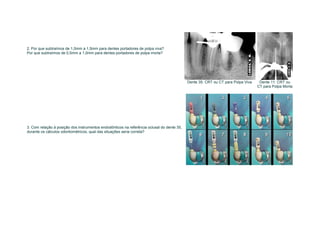 2. Por que subtraímos de 1,0mm a 1,5mm para dentes portadores de polpa viva?
Por que subtraímos de 0,5mm a 1,0mm para dentes portadores de polpa morta?




                                                                                            Dente 35: CRT ou CT para Polpa Viva    Dente 11: CRT ou
                                                                                                                                  CT para Polpa Morta




3. Com relação à posição dos instrumentos endodônticos na referência oclusal do dente 35,
durante os cálculos odontométricos, qual das situações seria correta?
 