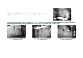 4. Radiografia do dente 26 para prova dos cones principais de obturação, qual técnica
radiográfica foi utilizada, por que e identifique os canais, a partir da mesial?




5. Radiografias tomadas durante os cálculos odontométricos A, B e C. Com relação à anatomia dos canais radiculares, responder conforme perguntas nas
legendas das imagens radiográficas, bem como a técnica radiográfica utilizada e identifique os canais, a partir da mesial:




 A. dente 46, PM, RX de confirmação do                    B. dente 36, PM, RX de confirmação do                C. dente 47, PV, RX de confirmação do
      CT, o que podemos concluir?                              CT, o que podemos concluir?                          CT, o que podemos concluir?
 