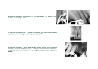 6. Radiografia tomada para confirmação do CRT ou CT dos dentes 21 e 15, descreva o que
aconteceu e como corrigir o erro?




7. Radiografia de confirmação do CT do dente 11, portador de polpa morta, o limite de trabalho
encontra-se correto, existe algum problema que chama atenção?




8. Radiografia tomada para o cálculo do X do dente 25, portador de polpa morta. Qual técnica
radiográfica foi utilizada, identificar os canais e, o que provavelmente aconteceu com relação a
ultrapassagem dos instrumentos além do vértice radiográfico e quais consequências podemos
esperar?
 
