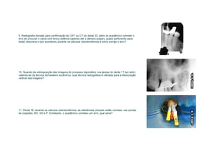 9. Radiografia tomada para confirmação do CRT ou CT do dente 33, além do acadêmico cometer o
erro de procurar o canal com broca esférica (apenas até a câmara pulpar), quase perfurando para
distal, descreva o que aconteceu durante os cálculos odontométricos e como corrigir o erro?




10. Quando da sobreposição das imagens do processo zigomático nos ápices do dente 17 (ao lado),
valendo-se da técnica da bissetriz excêntrica, qual técnica radiográfica é utilizada para a dissociação
vertical das imagens?




11. Dente 16, durante os cálculos odontométricos, as referências oclusais estão corretas, nas pontas
de cúspides, MV, VD e P. Entretanto, o acadêmico cometeu um erro, qual seria?
 