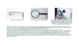 Régua milmetrada transparente                  Lupa de aumento com armação plástica            Mensuração do Comprimento Aparente de Dente
                                                                                                       (CAD - distância em milímetros da borda incisal
                                                                                                        ou oclusal e vértice radiográfico), por meio da
                                                                                                       radiografia inicial, negatoscópio radiográfico (fundo
                                                                                                            branco), régua, lupa, luvas e sobreluvas.

Após anamnese, diagnóstico clínico provável, valor do CAD, anestesia, isolamento relativo e absoluto, cirurgia de acesso e exploração / esvaziamento /
preparo da entrada do canal será necessário a utilização de instrumentos endodônticos do tipo K (representados no cabo por um quadrado), limitadores -
 cursores - stops de silicone e régua calibradora para instrumentos endodônticos autoclaváveis.
De acordo com a anatomia do dente observada na radiografia inicial, comprimento e diâmetro, selecionamos o instrumento do tipo K.
Com relação ao comprimento, dentes com o CAD até 21mm é óbvio a seleção de limas com 21mm e, respectivamente para os dentes até 25mme 31mm.
O diâmetro é selecionado, por meio da introdução e prova do instrumento previamente calibrado no comprimento desejado (CRI - comprimento real do
instrumento ou CI - comprimento inicial), porém o instrumento a ser provado não deverá ficar folgado nem muito justo no interior do canal, o que
representaria respectivamente a possibilidade da lima cair durante a tomada radiográfica, bem como a extrusão (empurrar) tecidos saudáveis ou produtos
tóxicos quando da mortificação pulpar para o periápice, acarretando agudização (dor) ou interferindo negativamente no processo de reparo cicatricial pós-
tratamento endodôntico.
 