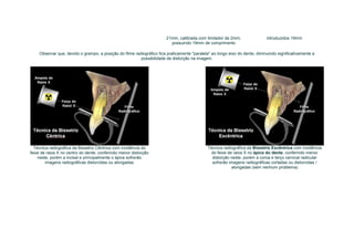 21mm, calibrada com limitador de 2mm,                 introduzidos 19mm
                                                                         possuindo 19mm de comprimento

    Observar que, devido o grampo, a posição do filme radiográfico fica praticamente "paralela" ao longo eixo do dente, diminuindo significativamente a
                                                         possibilidade de distorção na imagem.




  Técnica radiográfica da Bissetriz Cêntrica com incidência do                               Técnica radiográfica da Bissetriz Excêntrica com incidência
feixe de raios X no centro do dente, conferindo menor distorção                               do feixe de raios X no ápice do dente, conferindo menor
    neste, porém a incisal e principalmente o ápice sofrerão                                   distorção neste, porém a coroa e terço cervical radicular
        imagens radiográficas distorcidas ou alongadas                                         sofrerão imagens radiográficas cortadas ou distorcidas /
                                                                                                         alongadas (sem nenhum problema)
 
