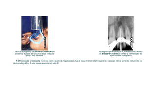 Técnica radiográfica da Bissetriz Exêntricacom                                                      Radiografia para cálculo do X, tomada com a técnica
 incidência do feixe de raios X no terço radicular                                                   da Bissetriz Excêntrica. Manter a centralização do
              apical, seta vermelha                                                                               ápice no filme radiográfico

   4-) Processada a radiografia, mede-se, com o auxilio do negatoscópio, lupa e régua milimetrada transparente, o espaço entre a ponta do instrumento e o
vértice radiográfico. A esta medida teremos um valor X.
 