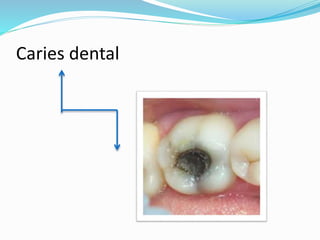 Caries dental
 