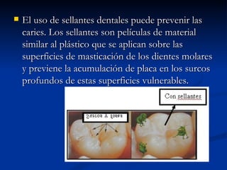 El uso de sellantes dentales puede prevenir las caries. Los sellantes son películas de material similar al plástico que se aplican sobre las superficies de masticación de los dientes molares y previene la acumulación de placa en los surcos profundos de estas superficies vulnerables. 